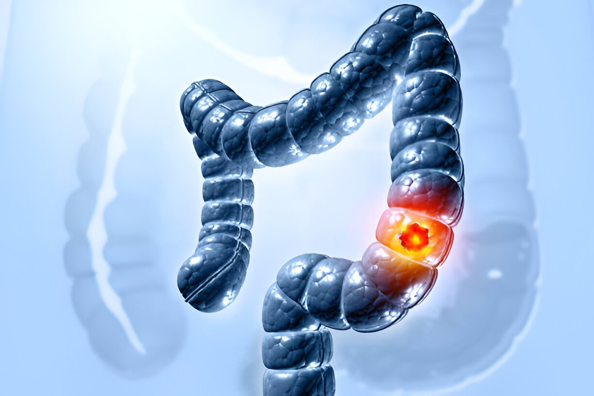 How is colorectal cancer diagnosed